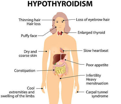 Hypothyroidism