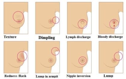 Breast cancer Symptoms