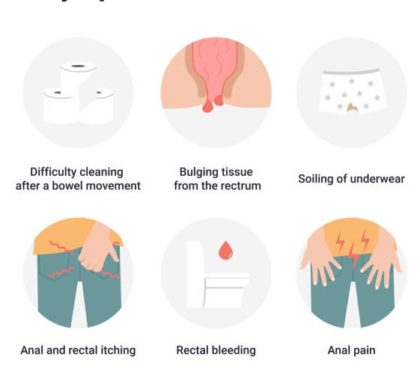 Symptoms of Piles