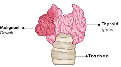 Thyroid cancer 